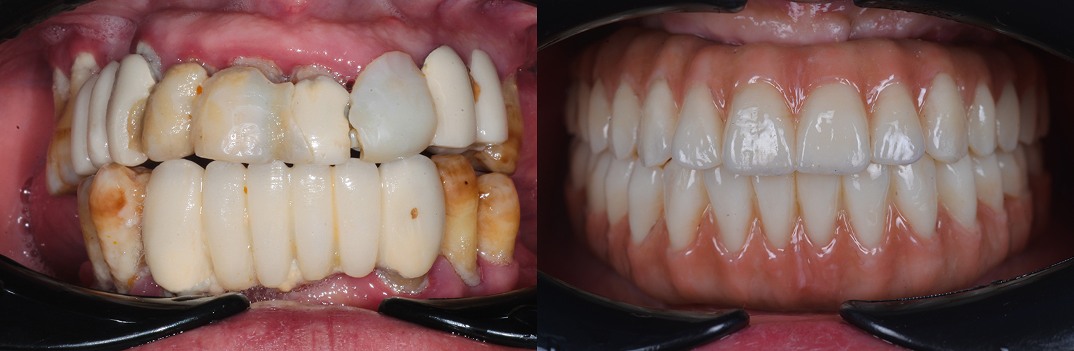 Prothèse All on 4 All on 6 sur implants dentaires - Oralys Tunis