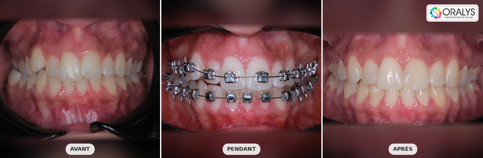 Traitement orthodontique à Tunis : avant, pendant et après bagues dentaires – Dr Anice Necibi, cabinet Oralys